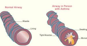 दमा (श्वास रोग ) Asthma